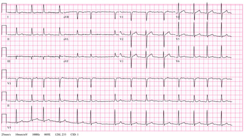 Fibrillazione Atriale